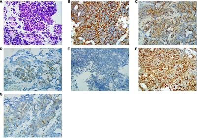 Corrigendum: Cardiac infarction caused by PD-1 inhibitor during small cell neuroendocrine carcinoma of the ureter treatment: a case report